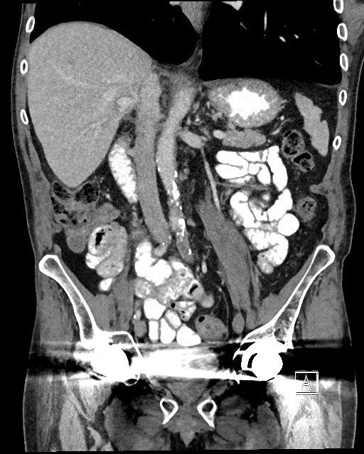 Acute renal infarction - rim capsular enhancement (Radiopaedia 59833-67270 Coronal C+ portal venous phase 27).jpg
