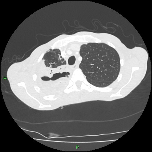 Acute right lung abscess (Radiopaedia 34806-36258 Axial lung window 37).jpg