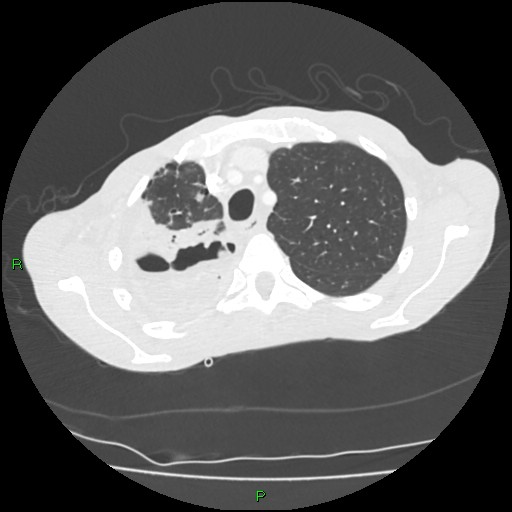 File:Acute right lung abscess (Radiopaedia 34806-36258 Axial lung window 38).jpg