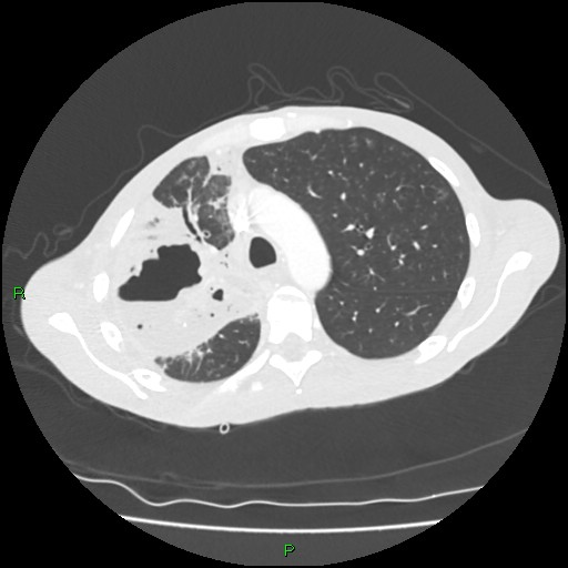 Acute right lung abscess (Radiopaedia 34806-36258 Axial lung window 57).jpg