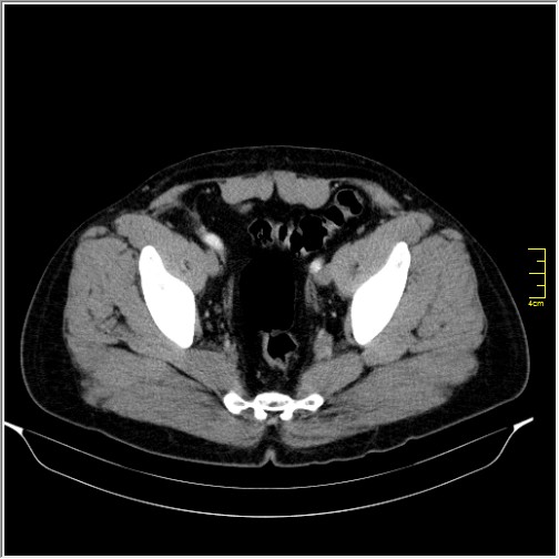 Acute right sided diverticulitis (Radiopaedia 65249-74268 Axial C+ portal venous phase 69).JPG