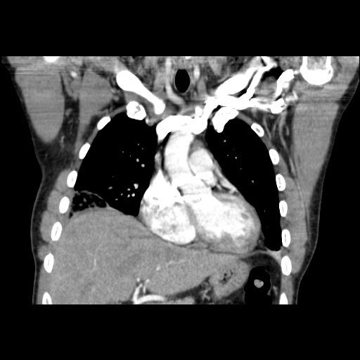 Acute segmental pulmonary emboli and pulmonary infarction (Radiopaedia 62264-70444 Coronal C+ CTPA 16).jpg