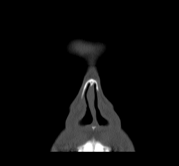 File:Acute sinusitis (Radiopaedia 23161-23215 Coronal bone window 15).jpg