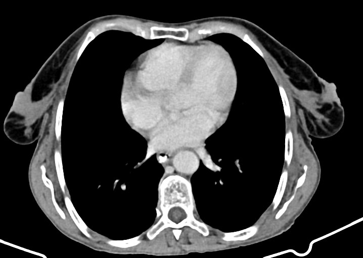 Acute small bowel (ileal) volvulus (Radiopaedia 71740-82139 Axial C+ portal venous phase 25).jpg