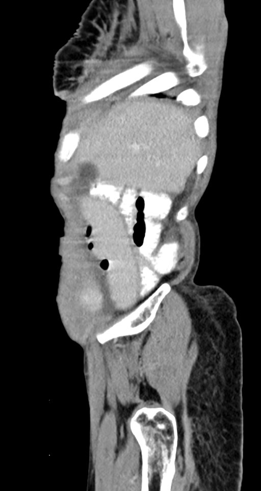 Acute small bowel (ileal) volvulus (Radiopaedia 71740-82139 Sagittal C+ portal venous phase 141).jpg
