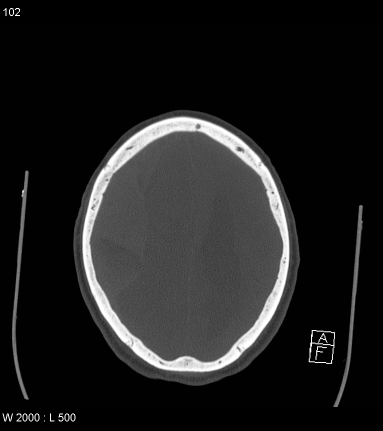 Acute subdural hematoma with myelofibrosis (Radiopaedia 52582-58494 Axial bone window 51).jpg