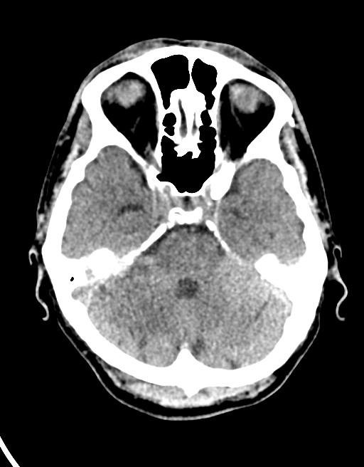 Acute superior cerebellar artery territory infarct (Radiopaedia 84104-99359 Axial non-contrast 48).jpg