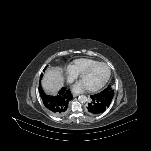 File:Acute superior mesenteric artery occlusion (Radiopaedia 51288-56960 Axial C+ portal venous phase 5).jpg