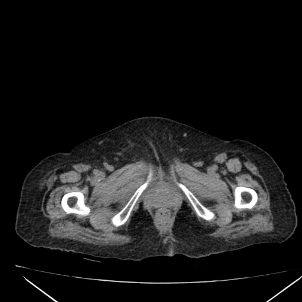 Acute tubular necrosis (Radiopaedia 28077-28334 F 73).jpg