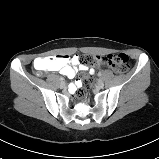 File:Acute uncomplicated appendicitis (Radiopaedia 61374-69304 Axial C+ portal venous phase 93).jpg