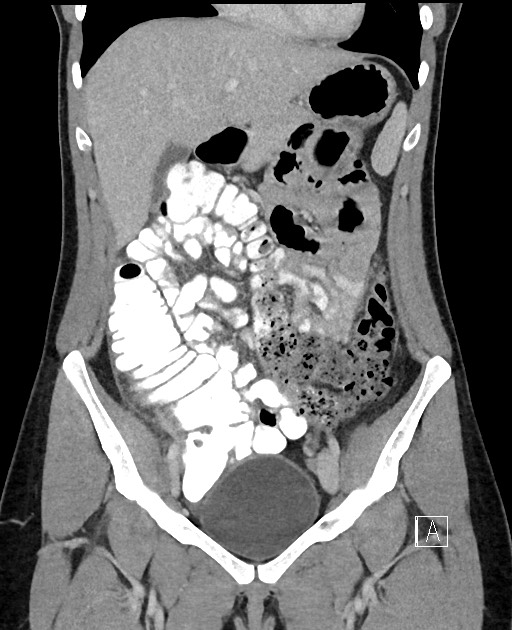 Acute uncomplicated appendicitis (Radiopaedia 61374-69304 Coronal C+ portal venous phase 36).jpg