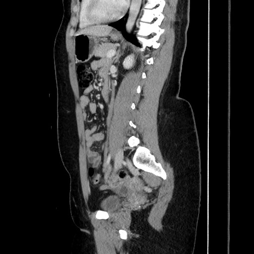Acute uncomplicated appendicitis (Radiopaedia 73704-84499 Sagittal C+ portal venous phase 128).jpg