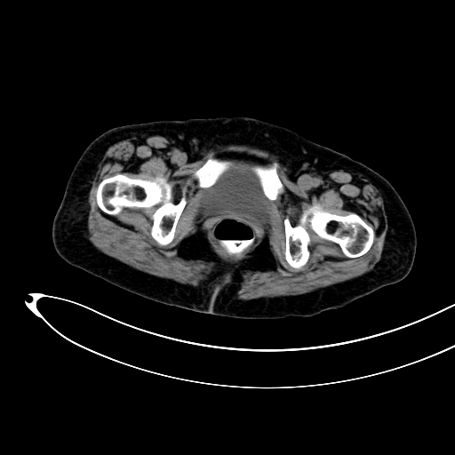 Adenocarcinoma colon with intussusception (Radiopaedia 86006-101922 Axial non-contrast 63).jpg