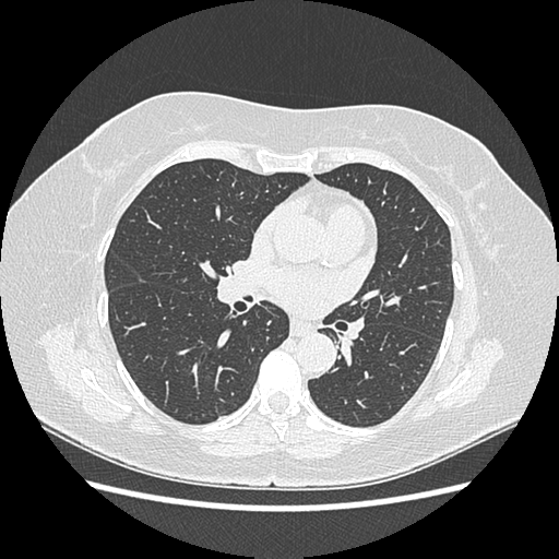 Adenocarcinoma in situ of lung (Radiopaedia 38685-40829 B 117).png