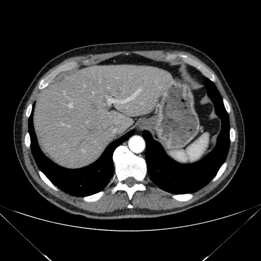 File:Adenocarcinoma of the lung (Radiopaedia 59871-67325 Axial C+ arterial phase 83).jpg