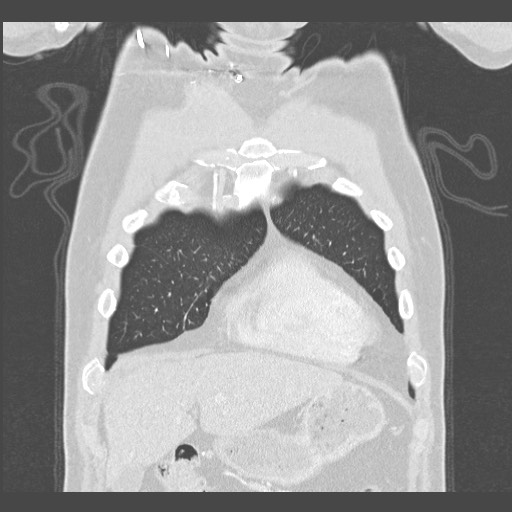 Adenocarcinoma of the lung (Radiopaedia 59871-67325 Coronal lung window 5).jpg