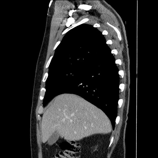 File:Adenocarcinoma of the lung (Radiopaedia 59871-67325 Sagittal C+ arterial phase 20).jpg