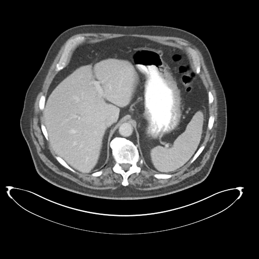 Adenocarcioma of rectum- T1 lesion (Radiopaedia 36921-38547 Axial C+ portal venous phase 20).png
