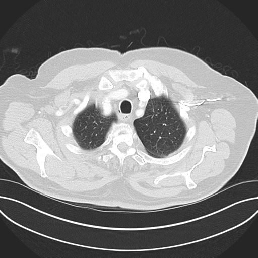 Adenocarcioma of rectum- T1 lesion (Radiopaedia 36921-38547 Axial lung window 12).png