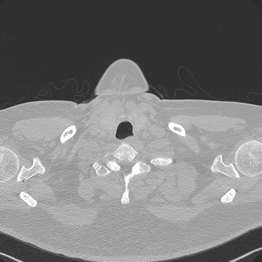 File:Adenoid cystic carcinoma of the trachea (Radiopaedia 49042-54137 Axial lung window 4).jpg