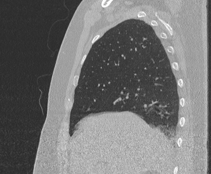 Adenoid cystic carcinoma of the trachea (Radiopaedia 49042-54137 Sagittal lung window 124).jpg