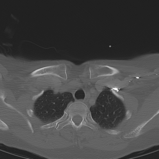 Adenoid cystic tumor of palate (Radiopaedia 46980-51518 Axial bone window 71).png