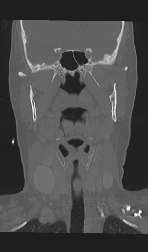 Adenoid cystic tumor of palate (Radiopaedia 46980-51518 Coronal bone window 32).png