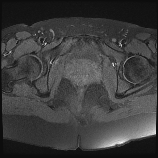 File:Adenomyosis-scar endometriosis (Radiopaedia 65863-75022 Axial T1 fat sat 23).jpg