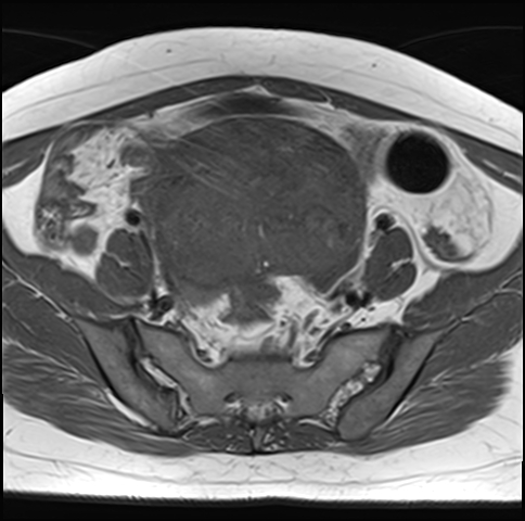 File:Adenomyosis - ovarian endometriomas (Radiopaedia 67031-76350 Axial T1 9).jpg