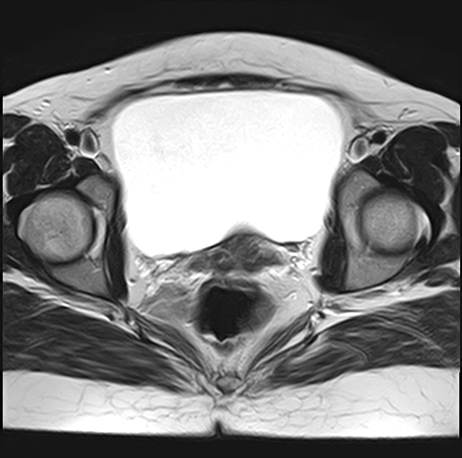 File:Adenomyosis - ovarian endometriomas (Radiopaedia 67031-76350 Axial T2 20).jpg