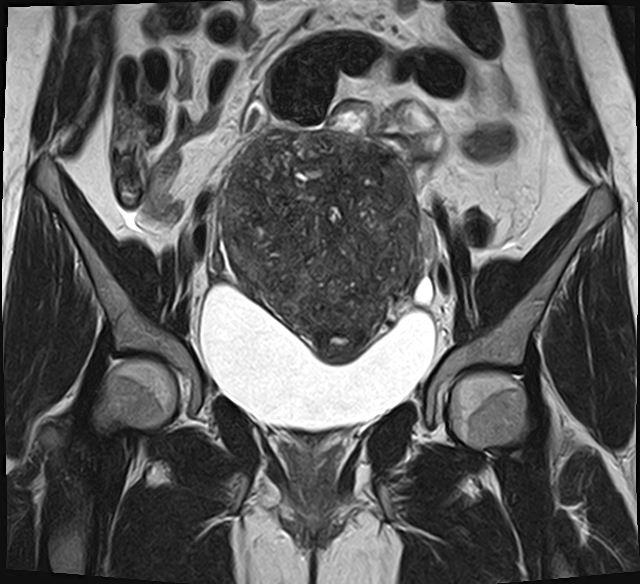 File:Adenomyosis - ovarian endometriomas (Radiopaedia 67031-76350 Coronal T2 12).jpg
