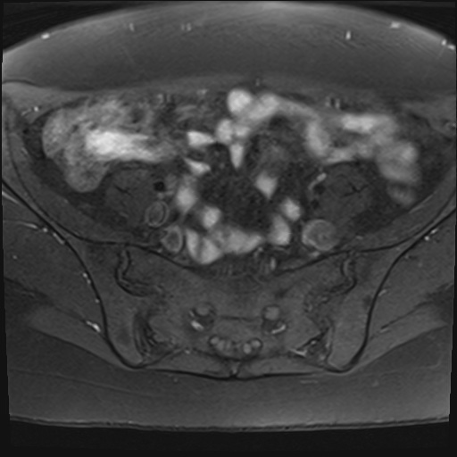 File:Adenomyosis and endometriotic cysts (Radiopaedia 82300-96367 Axial T1 fat sat 28).jpg