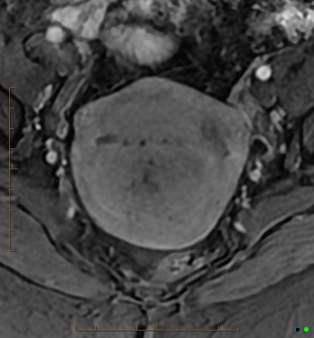 Adenomyosis uterus with hematometra (Radiopaedia 45779-50011 Axial T1 C+ fat sat 23).jpg