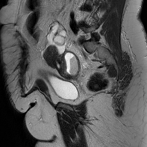 File:Adenomyosis within a didelphys uterus (Radiopaedia 70175-80215 Sagittal T2 25).jpg