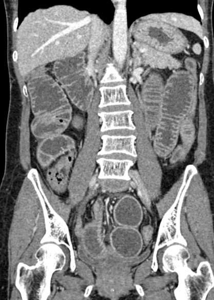 Adhesional small bowel obstruction (Radiopaedia 48397-53305 Coronal C+ portal venous phase 202).jpg