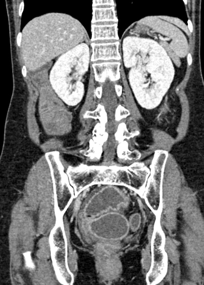Adhesional small bowel obstruction (Radiopaedia 48397-53305 Coronal C+ portal venous phase 245).jpg