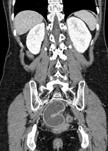 File:Adhesional small bowel obstruction (Radiopaedia 48397-53305 Coronal C+ portal venous phase 268).jpg