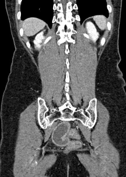 Adhesional small bowel obstruction (Radiopaedia 48397-53305 Coronal C+ portal venous phase 290).jpg