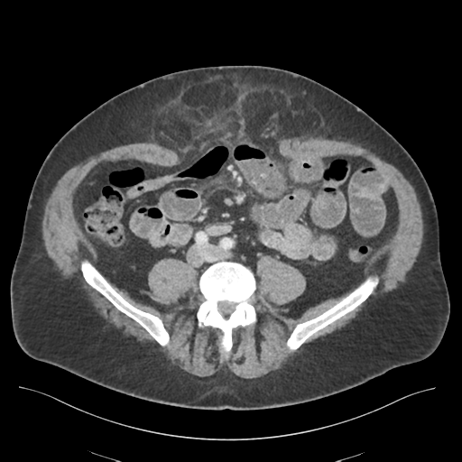 File:Adhesions within abdominal wall hernia (Radiopaedia 58283-65394 Axial C+ portal venous phase 53).png