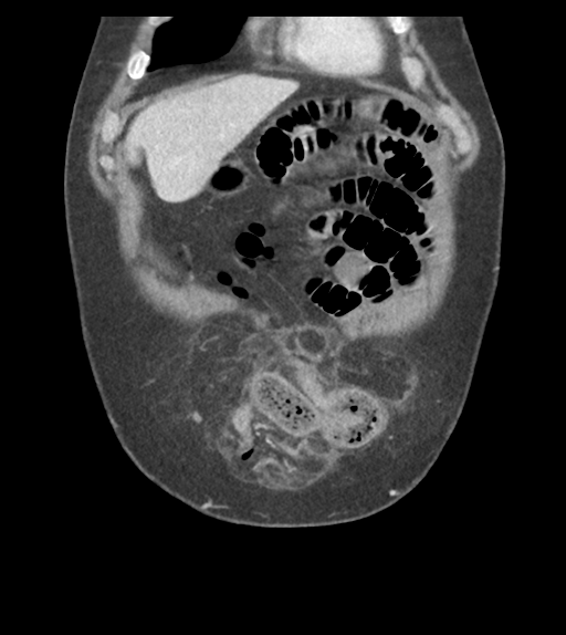Adhesions within abdominal wall hernia (Radiopaedia 58283-65394 Coronal C+ portal venous phase 16).png