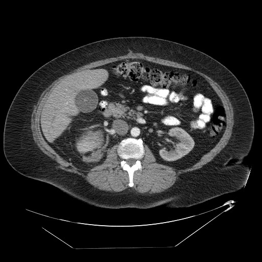 Adrenal angiosarcoma (Radiopaedia 81081-94671 Axial C+ arterial phase 36).jpg