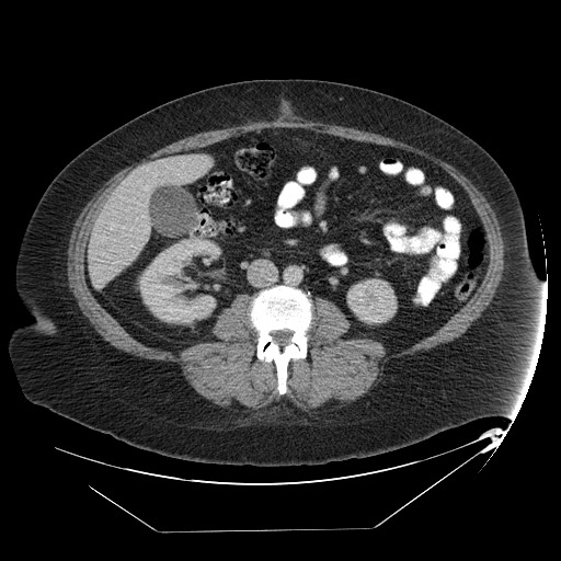 Adrenal angiosarcoma (Radiopaedia 81081-94671 Axial C+ portal venous phase 43).jpg