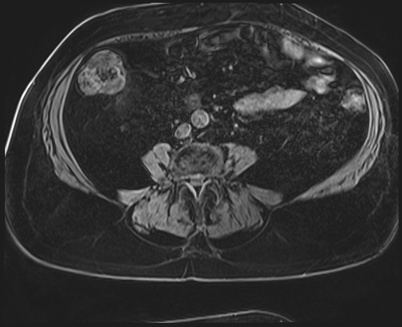 Adrenal cortical carcinoma (Radiopaedia 64017-72770 Axial T1 C+ fat sat 46).jpg