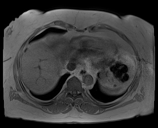 File:Adrenal cortical carcinoma (Radiopaedia 64017-72770 Axial T1 in-phase 1).jpg