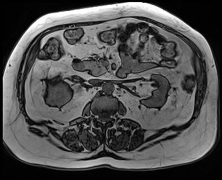 File:Adrenal cortical carcinoma (Radiopaedia 64017-72770 Axial T1 out-of-phase 40).jpg