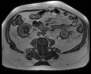 File:Adrenal cortical carcinoma (Radiopaedia 64017-72770 Axial T1 out-of-phase 55).jpg