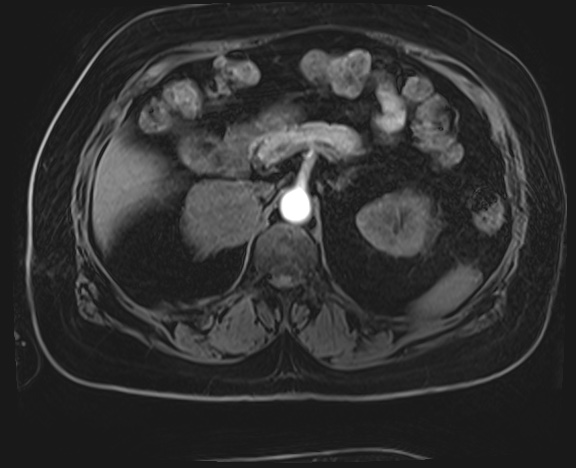 Adrenal cortical carcinoma (Radiopaedia 64017-72770 H 13).jpg