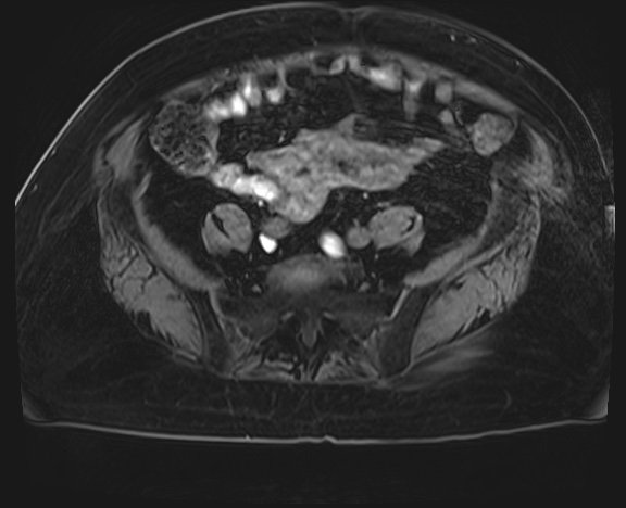 Adrenal cortical carcinoma (Radiopaedia 64017-72770 H 69).jpg