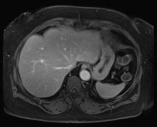 Adrenal cortical carcinoma (Radiopaedia 64017-72770 J 11).jpg