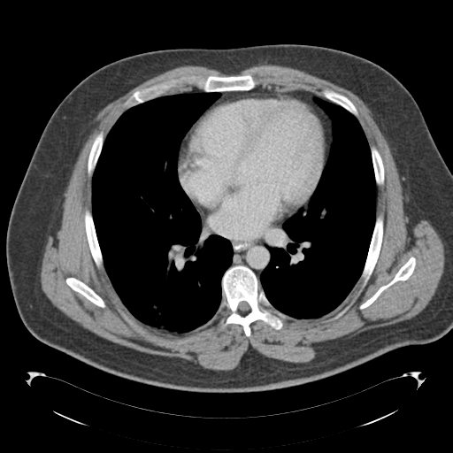 File:Adrenal cyst (Radiopaedia 45625-49776 Axial C+ portal venous phase 2).png